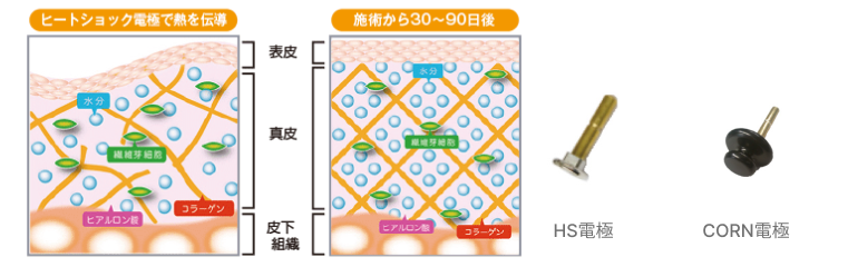 クリニックで人気、貝柱を立てる３Dリガメントセラピー！！Heat Shock 電極