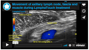 Lymphatouch 吸引（陰圧）による可動域拡大
