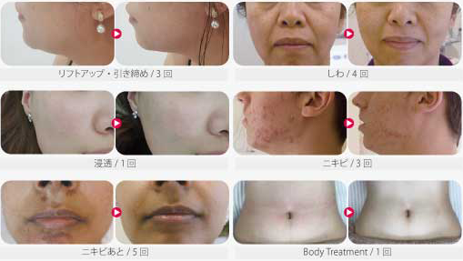 Before After
