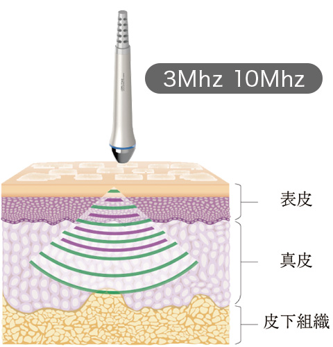 3Mhz 10Mhz 表皮 真皮 皮下組織
