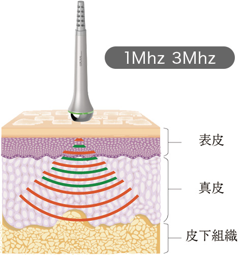 1Mhz 3Mhz 表皮 真皮 皮下組織