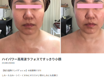 ハイパワー高周波ラフォスですっきり小顔 (coubic.com)
