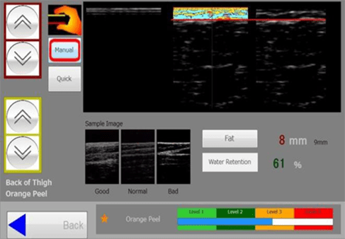Ultrasound Color Analysis Image/輝度解析